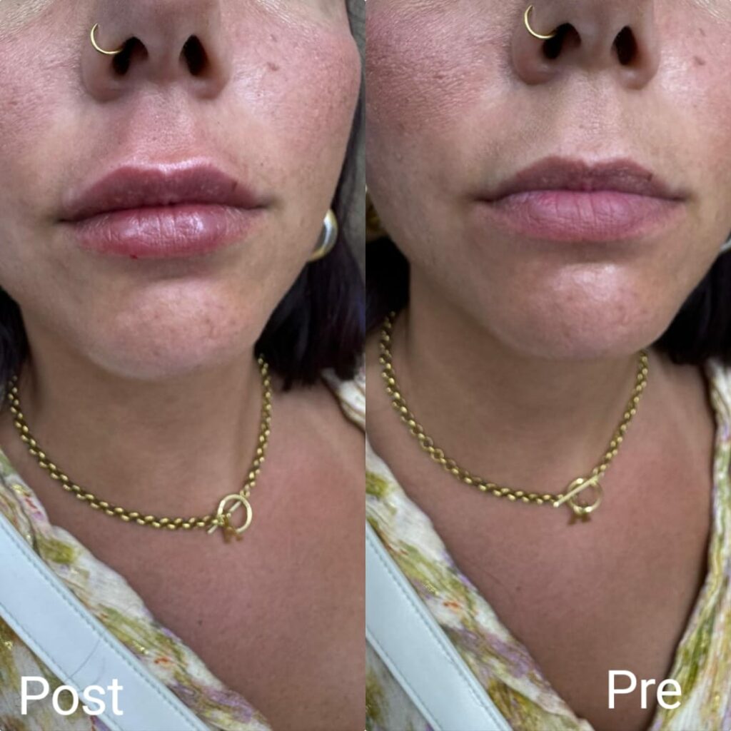 فيلر الشفايف قبل وبعد